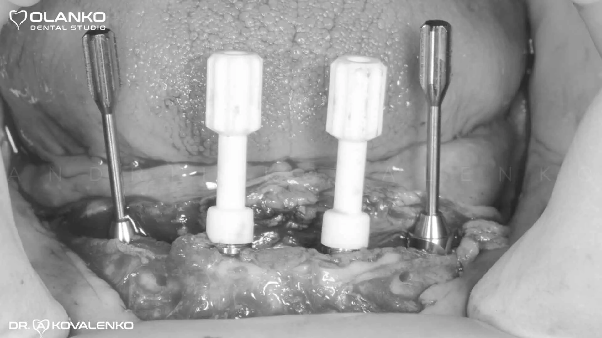 Клінічний віпадок 9 імплантація