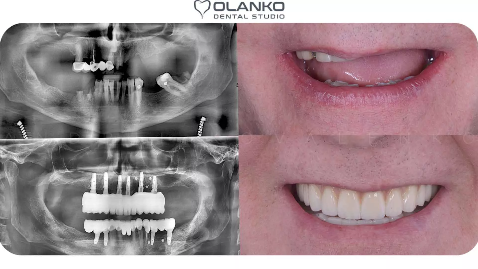 Фото приклад роботи по протезуванню&nbsp;при повній відсутності зубів на шести імплантатах на верхній щелепі