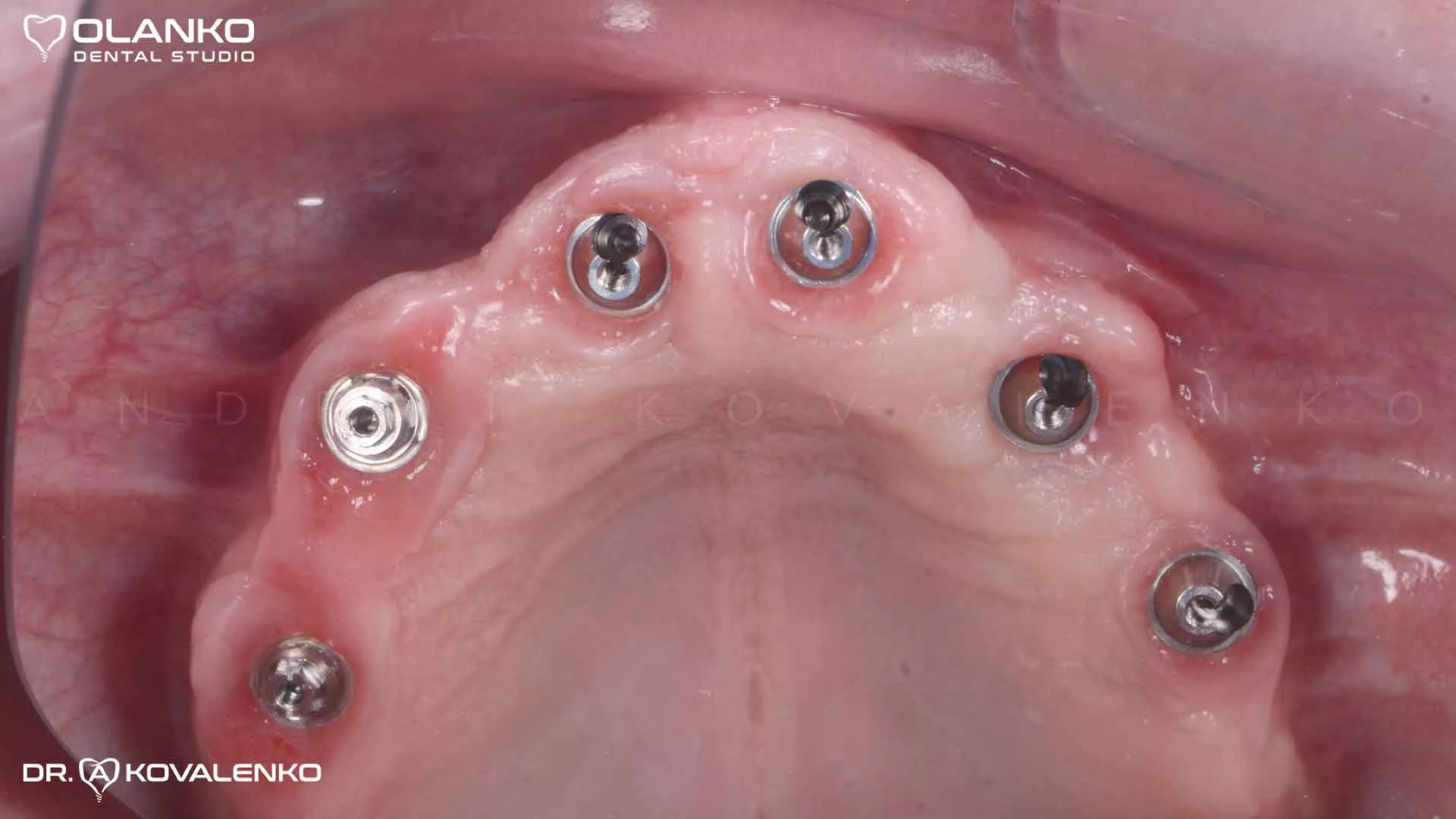 Фото приклад після установки шести імплантатів на верхню щелепу Оланко