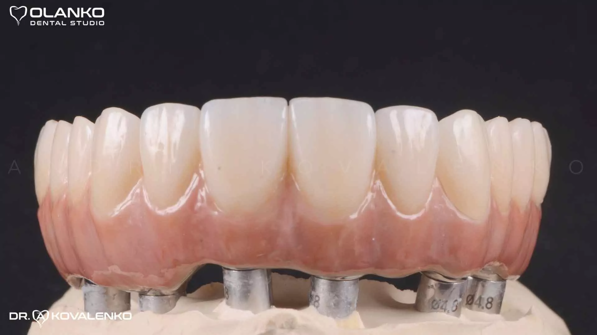 Фото суцільно-керамічного&nbsp;протезу, посилений фрезерованною&nbsp;титановою балкою на шести імплантатах Оланко