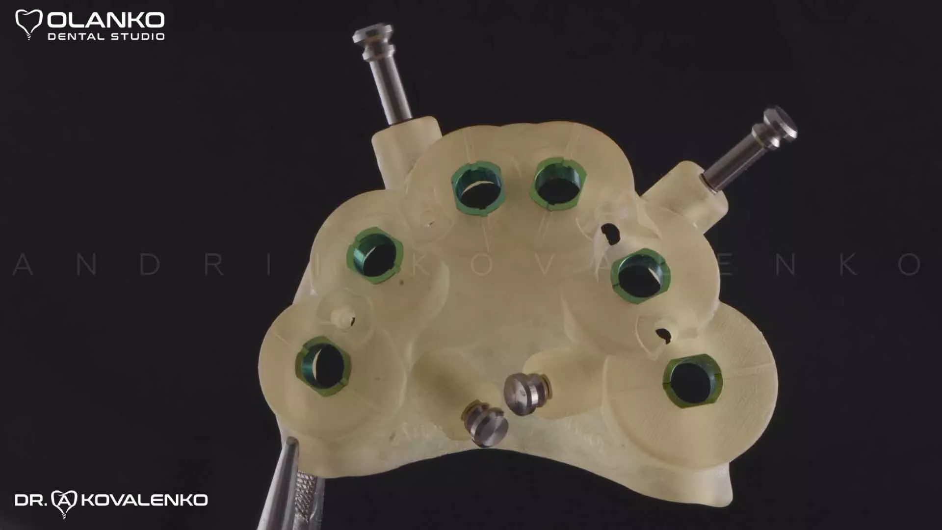 Клінічний випадок 7 імплантація