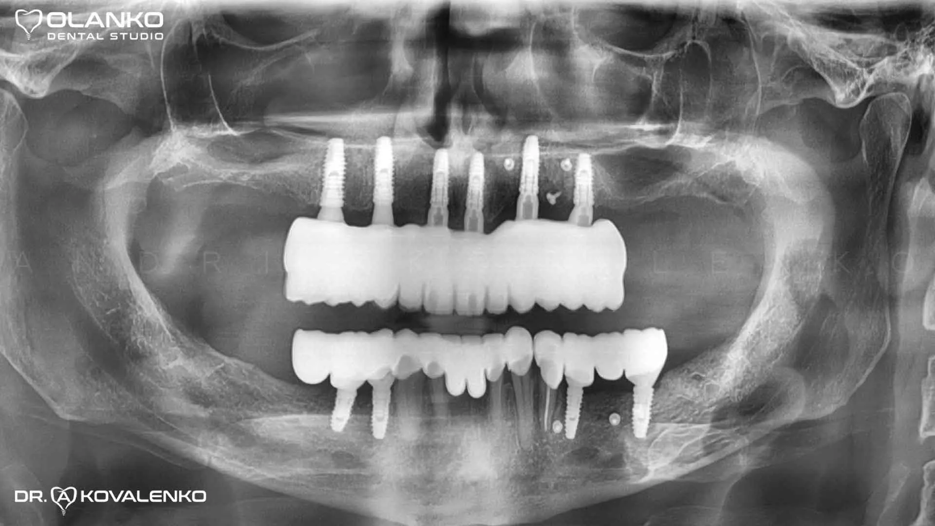 Клінічний випадок 7 імплантація