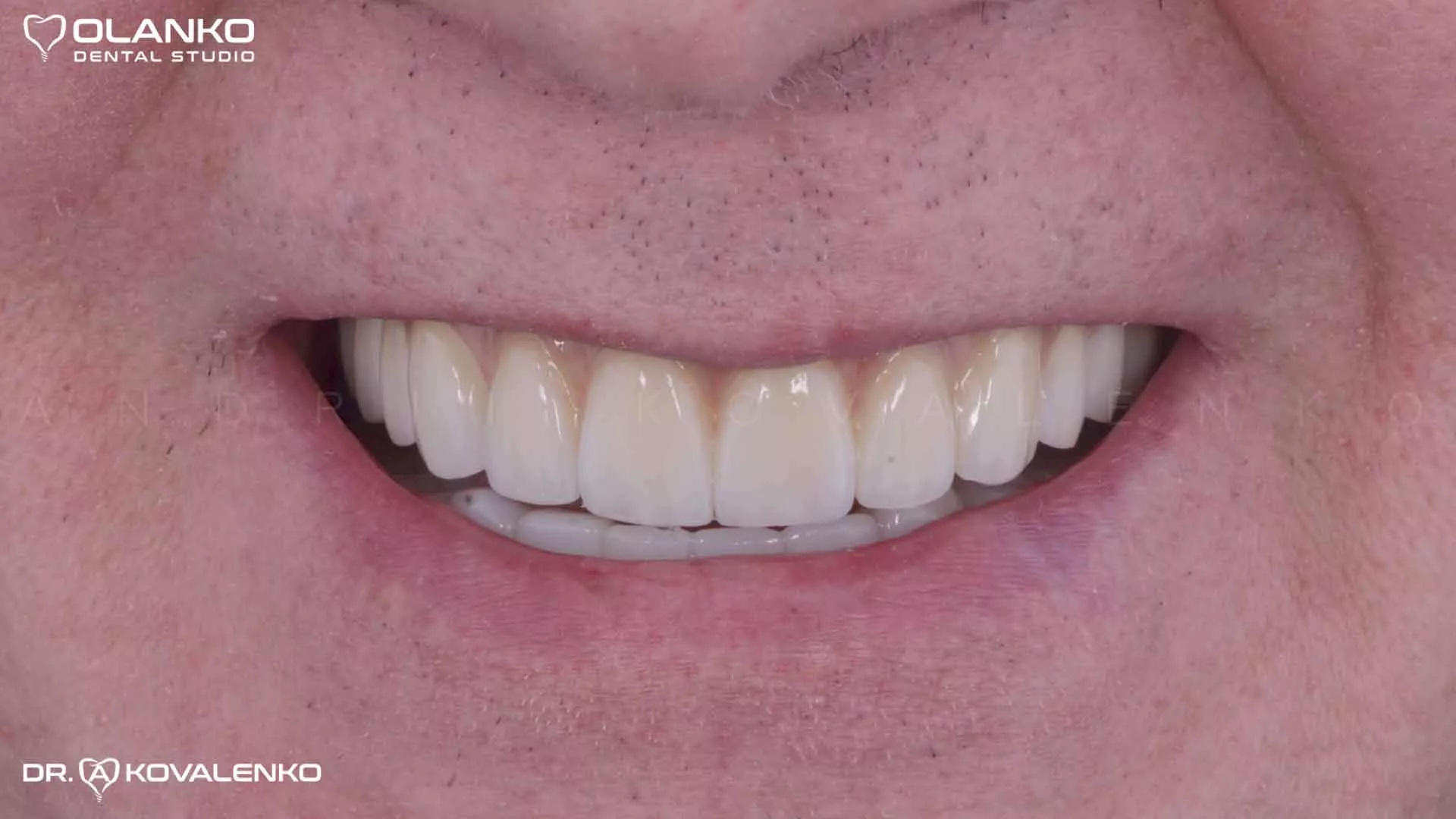 Клінічний випадок 7 імплантація