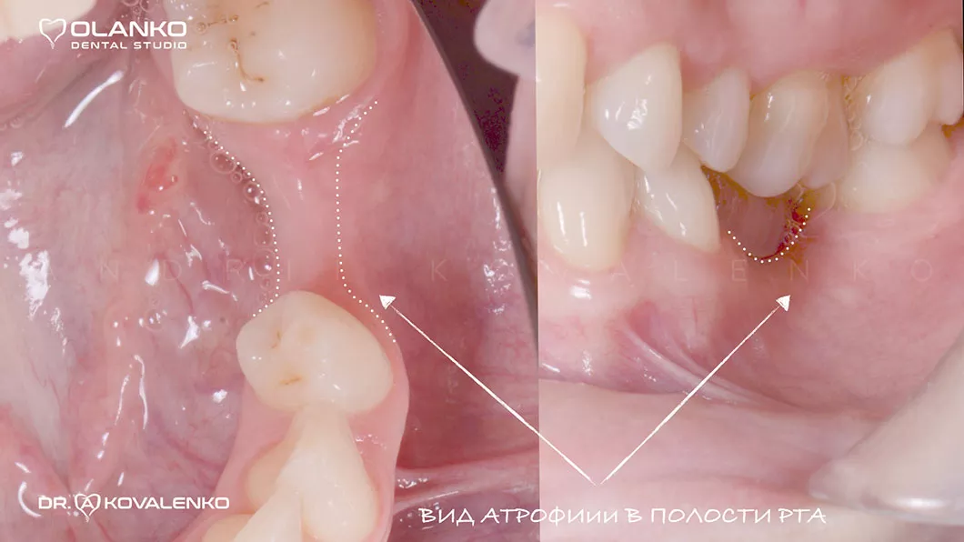 Атрофія - це прогресуюче зменшення кісткової тканини Оланко Броврари Київ