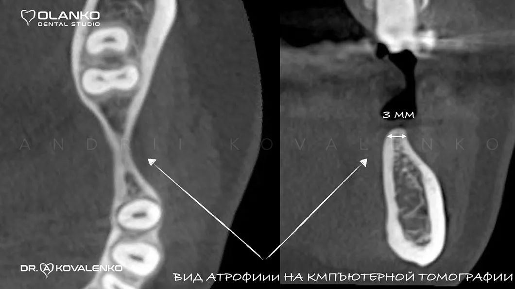 Кісткова пластика щелепи для імплантатів Оланко Бровари Київ