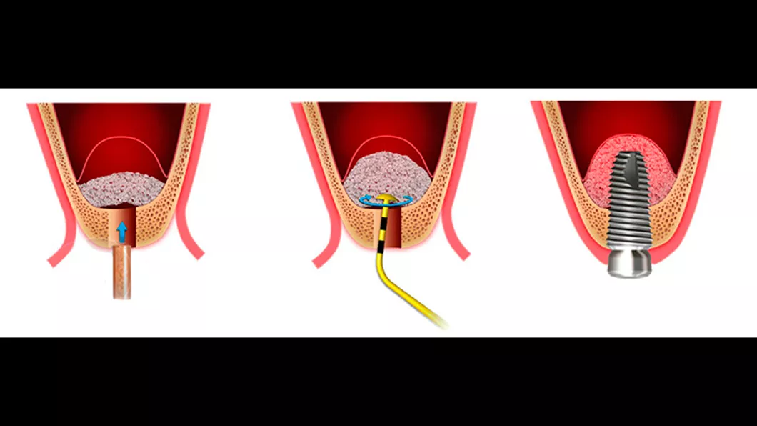 Кісткова пластика методом закритого синус ліфтингу Оланко Бровари Київ