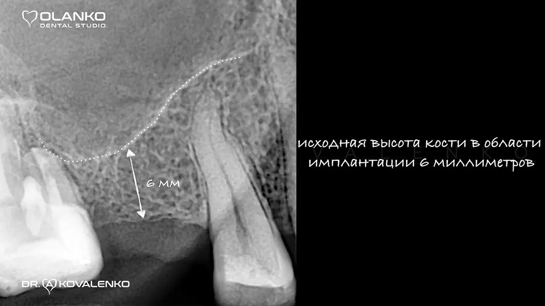 Кісткова пластика методом закритого синус-ліфтингу Фото 1