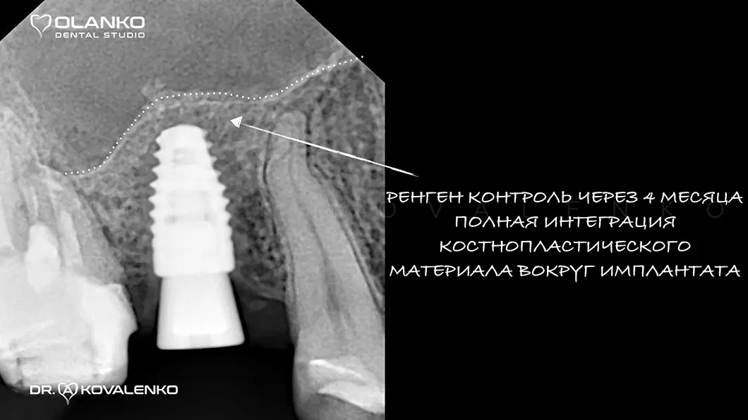 Кісткова пластика методом закритого синус-ліфтингу Фото 3