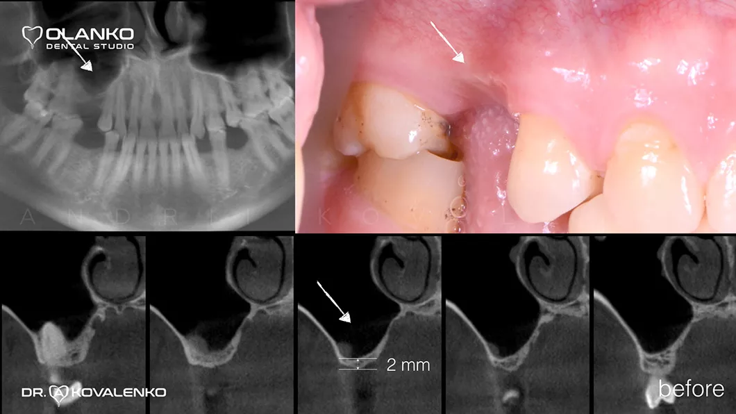 Кісткова пластика щелепи Бровари Київ Оланко