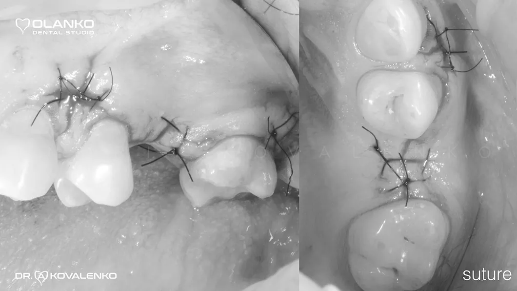 Кісткова пластика щелепи операція Оланко Бровари Київ