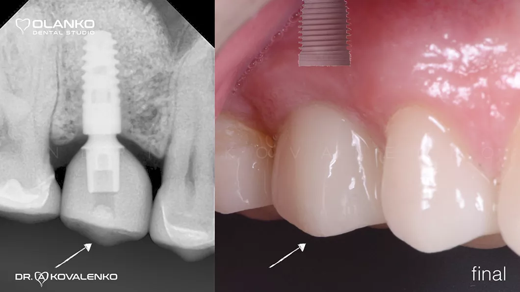 Кісткова пластика щелепи - коронка на імплант Оланко Бровари Київ