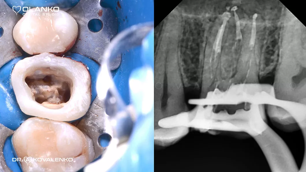 Очищення та&nbsp;дезинфекція систем&nbsp;кореневих каналів Київ Бровари