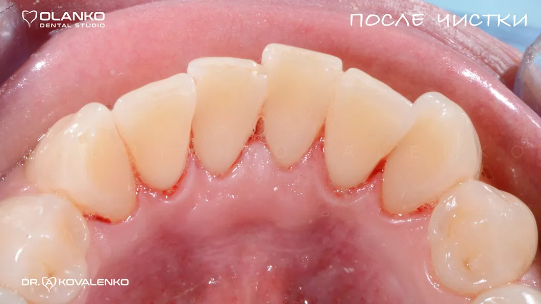 Після шліфування та полірування зубів