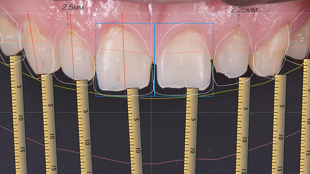 Процес створення дизайну посмішки Оланко Бровари Київ