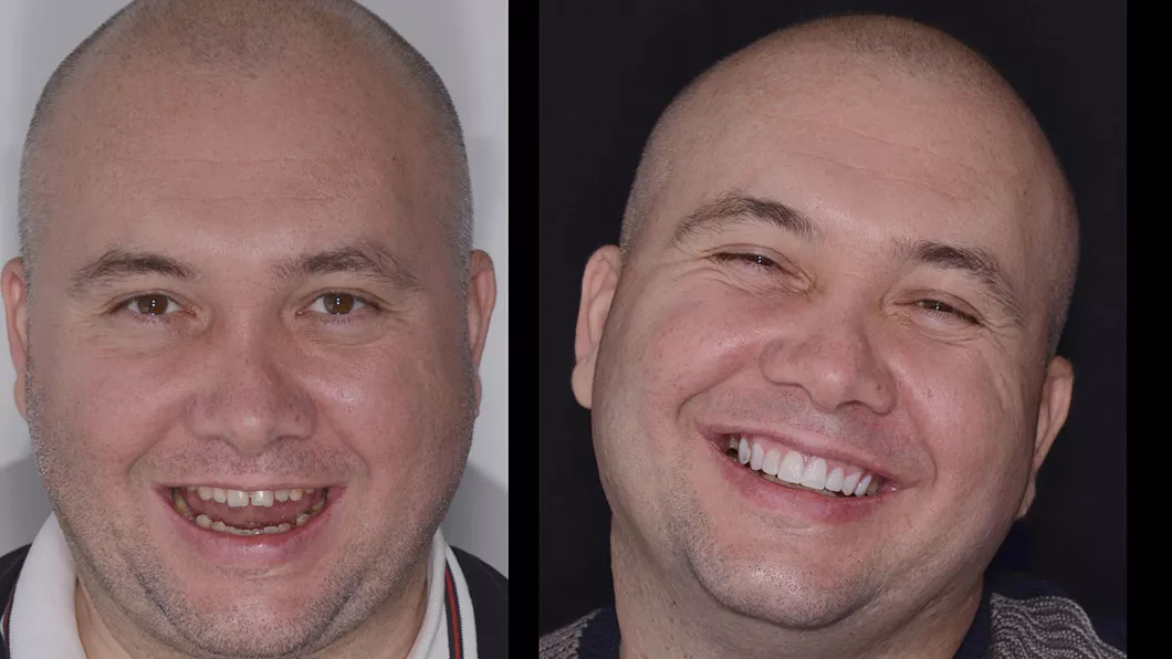 Фото до примірки макета перед встановленням вінірів Оланко Бровари Київ