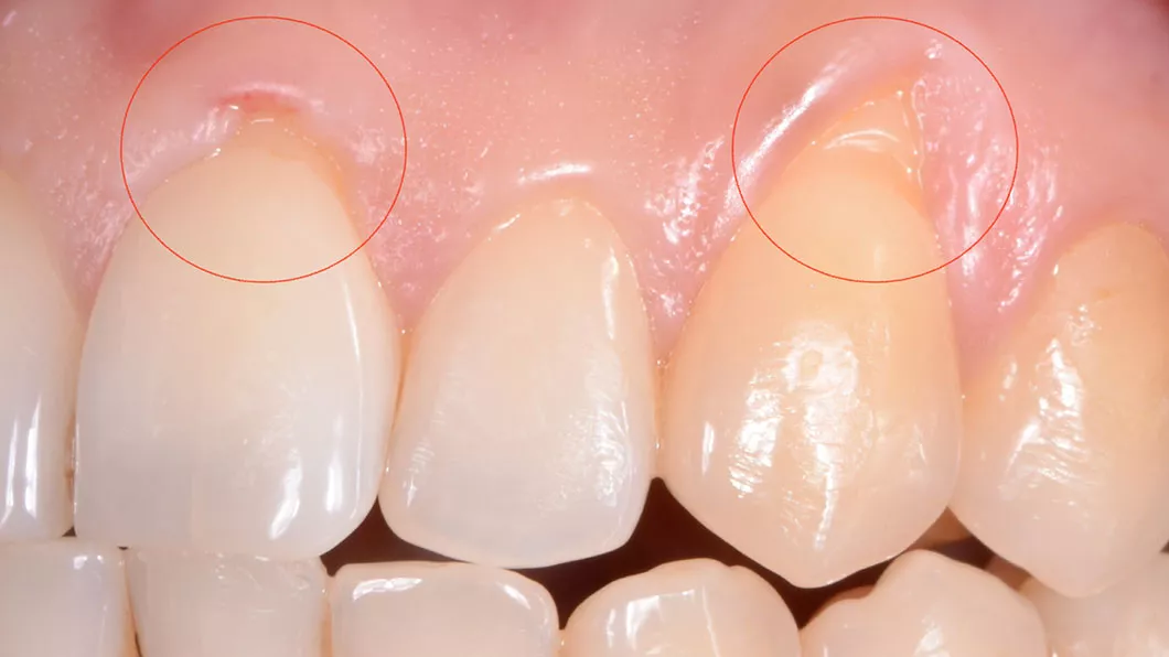 Пластика ясен, лікування ясен Оланко Бровари Київ Україна