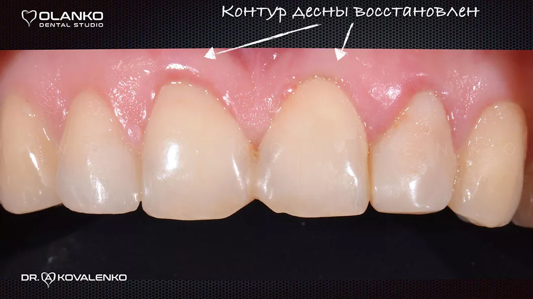 Пластика ясен, лікування ясен Оланко Бровари Київ фото 1