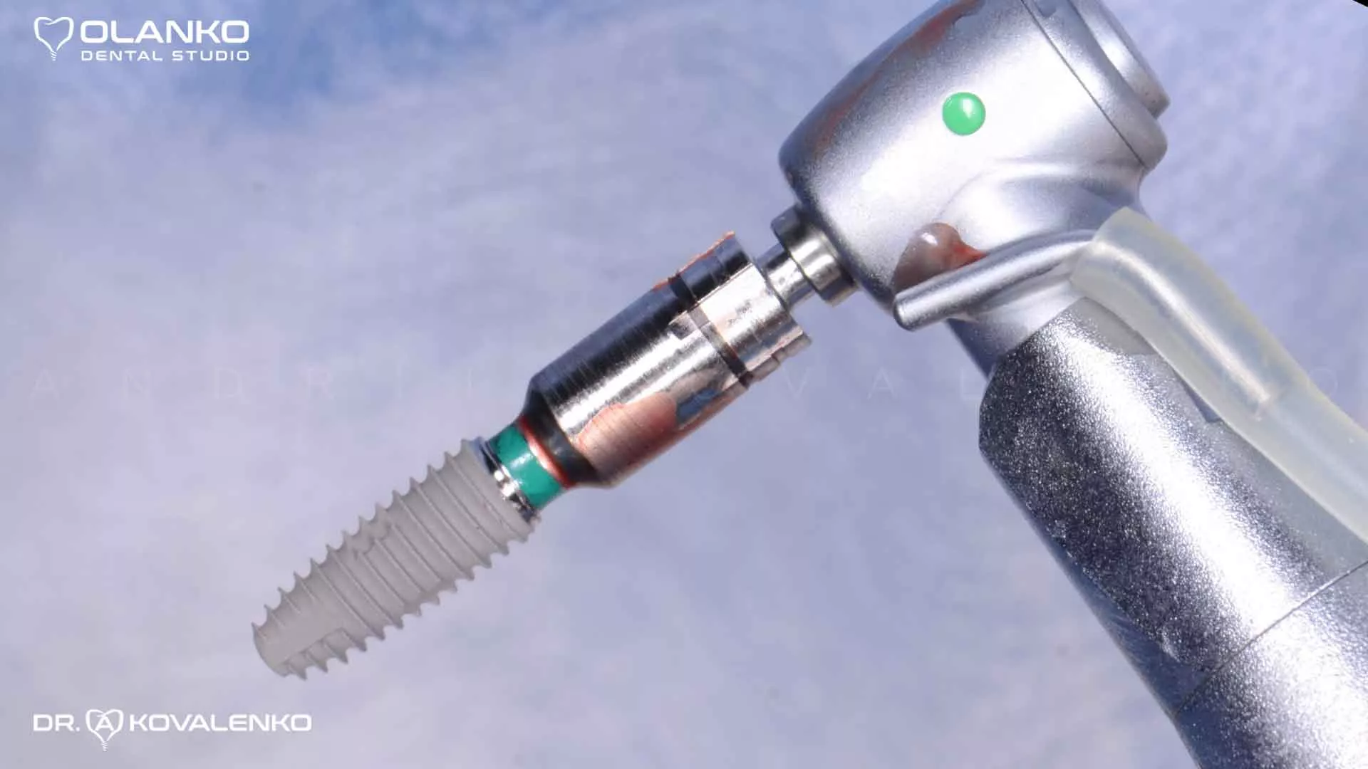 Клінічний випадок 6 імплантація