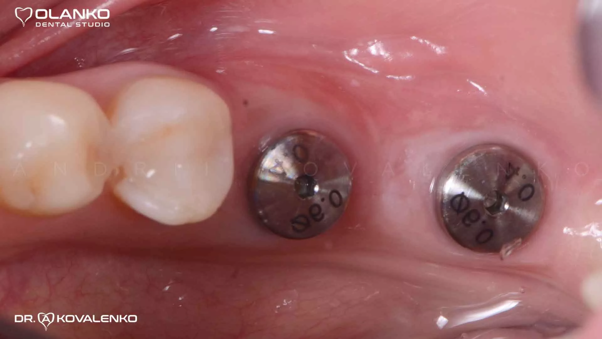 Клінічний випадок 6 імплантація