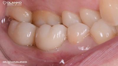 Імплантація зубів,приклади робіт до та після.Фотогалерея імплантація зубів.