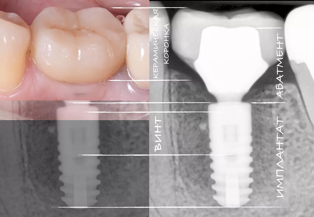<p>Слід знати, що <strong>зубний імплантат</strong