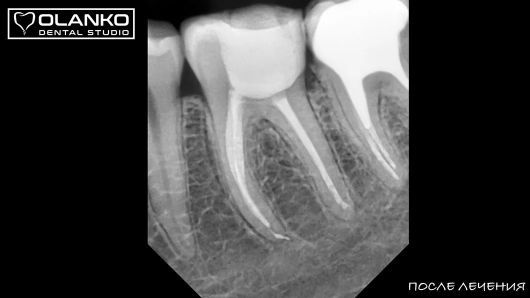 Основні показання до&nbsp;лікування кореневих каналів Київ Бровари