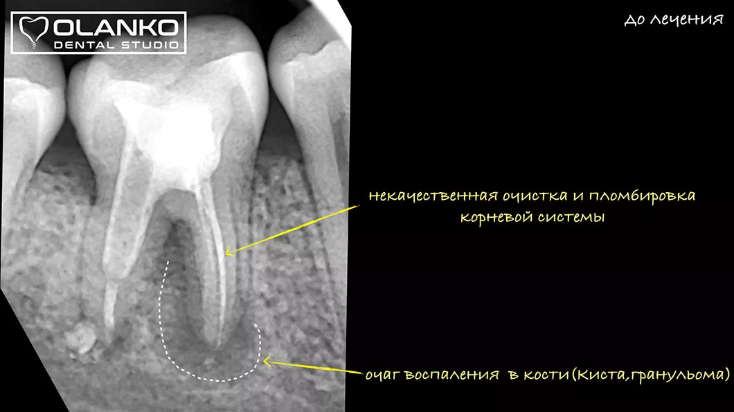 Лікування періодонтиту Київ Бровари Оланко 2