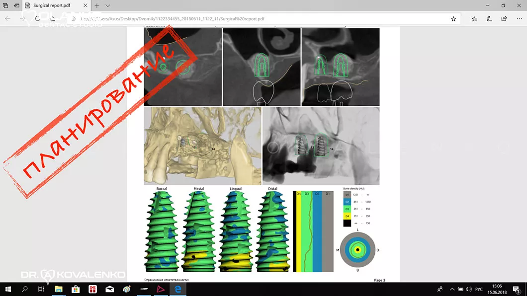 Навігаційна імплантація - встановлення зубних імплантів по шаблону фото 2 Оланко Бровари Київ