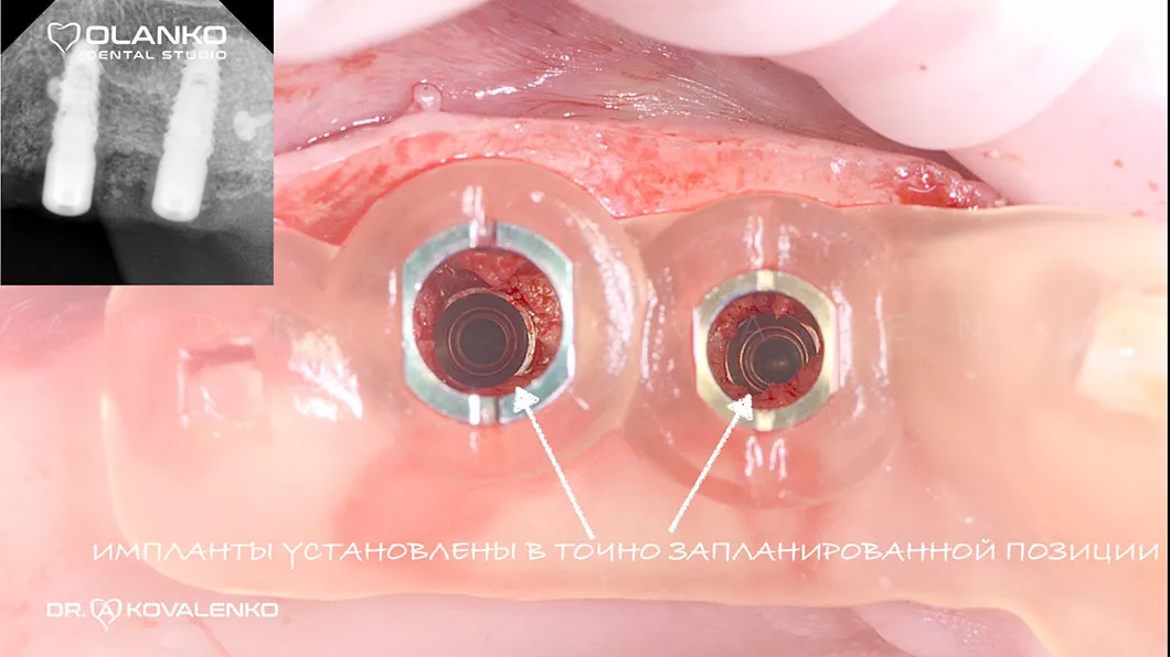 Навігаційна імплантація - встановлення зубних імплантів по шаблону фото 6 Оланко Бровари Київ
