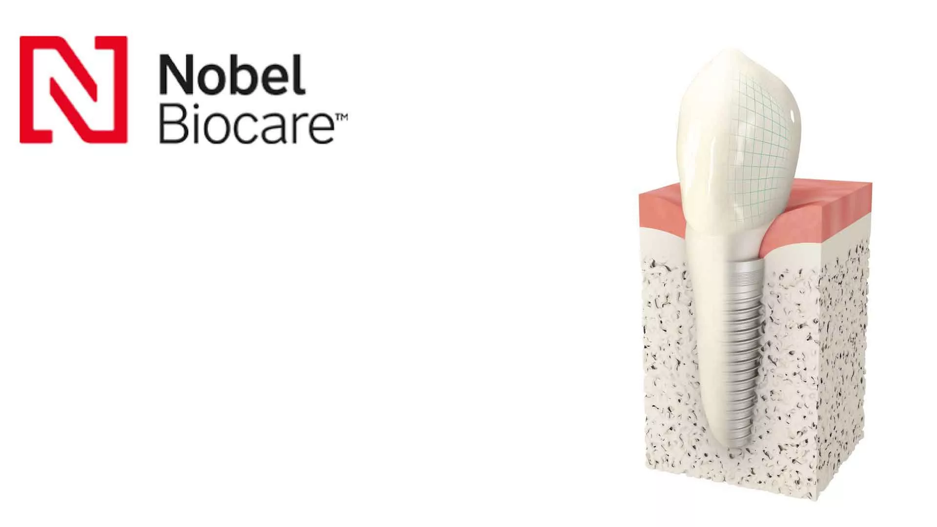 Який зубний імплантат краще? Огляд систем зубних імплантів