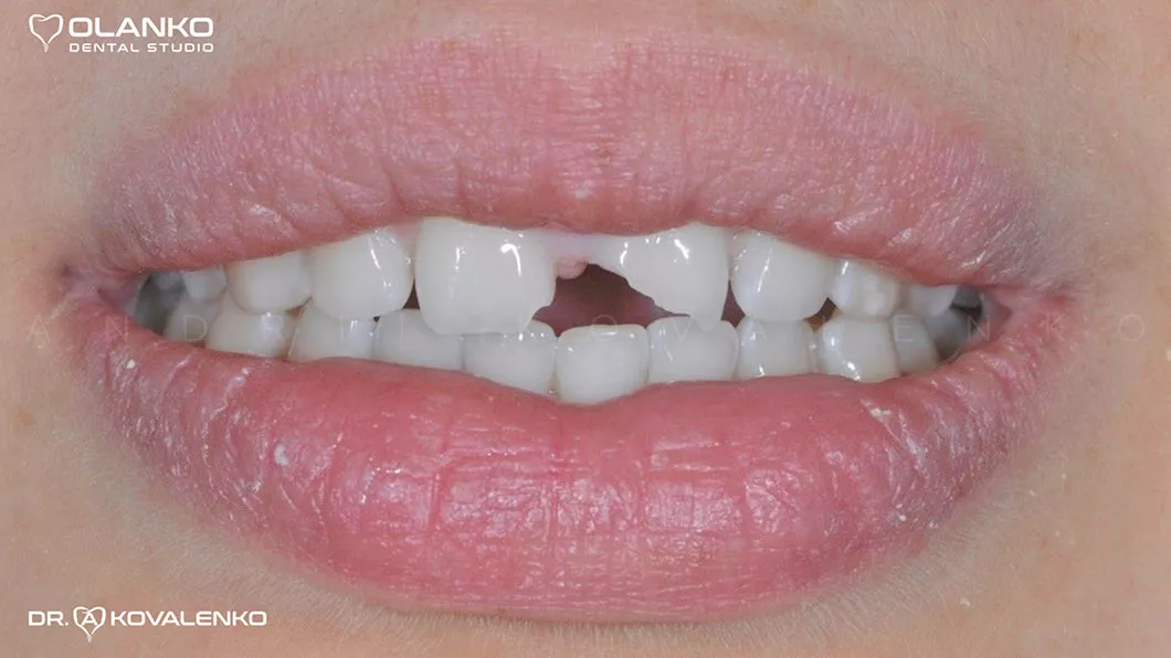 До Фото приклад&nbsp;художньої&nbsp;реставрації&nbsp;передних зубів&nbsp;фотополімером після&nbsp;травми, скола