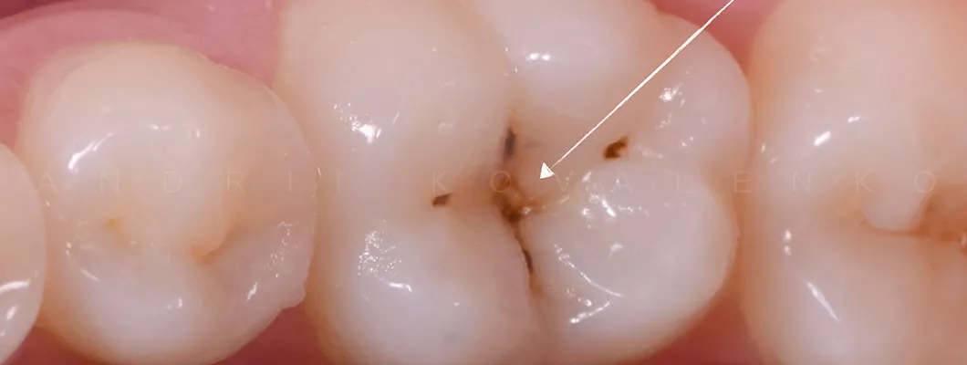 зуб поражен кариесом