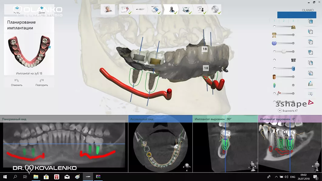 Програма для точної і безпечної установки імплантату Бровари Київ