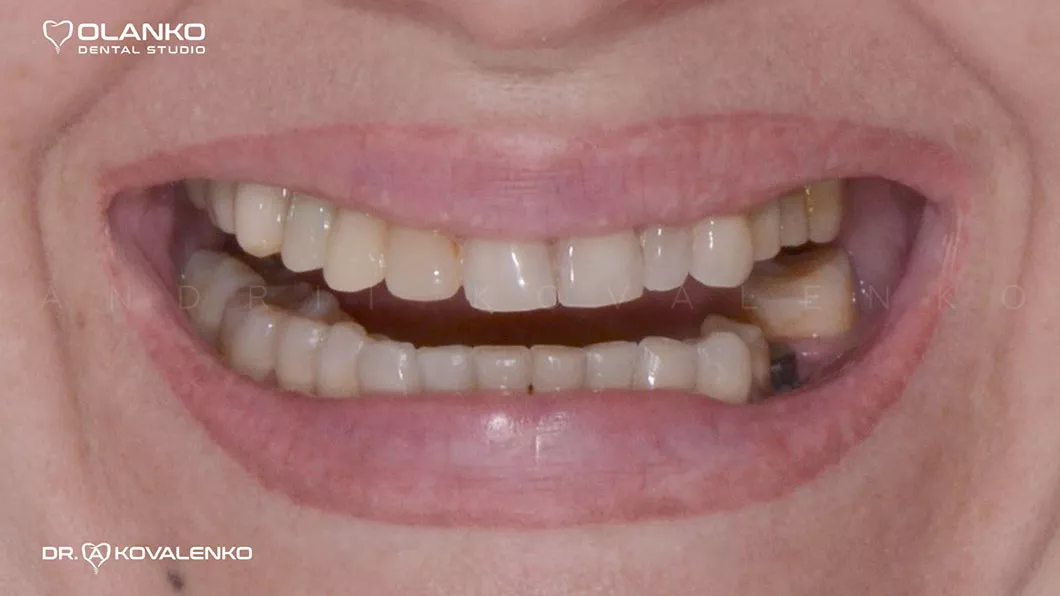 Фото посмішки до реконструкції за допомогою вінірів та коронок Оланко Бровари Київ