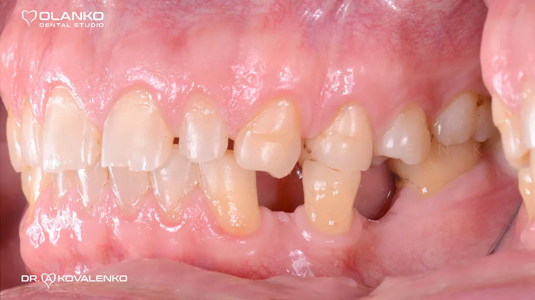 Фото зубів та стану прикусу до реконструкції вінірами та коронками з цільної кераміки Оланко Бровари Київ