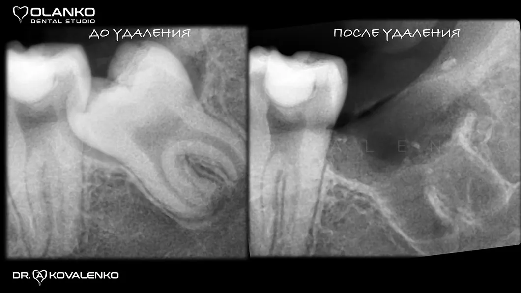 Видалення складних зубів мудрості Оланко Бровари Київ