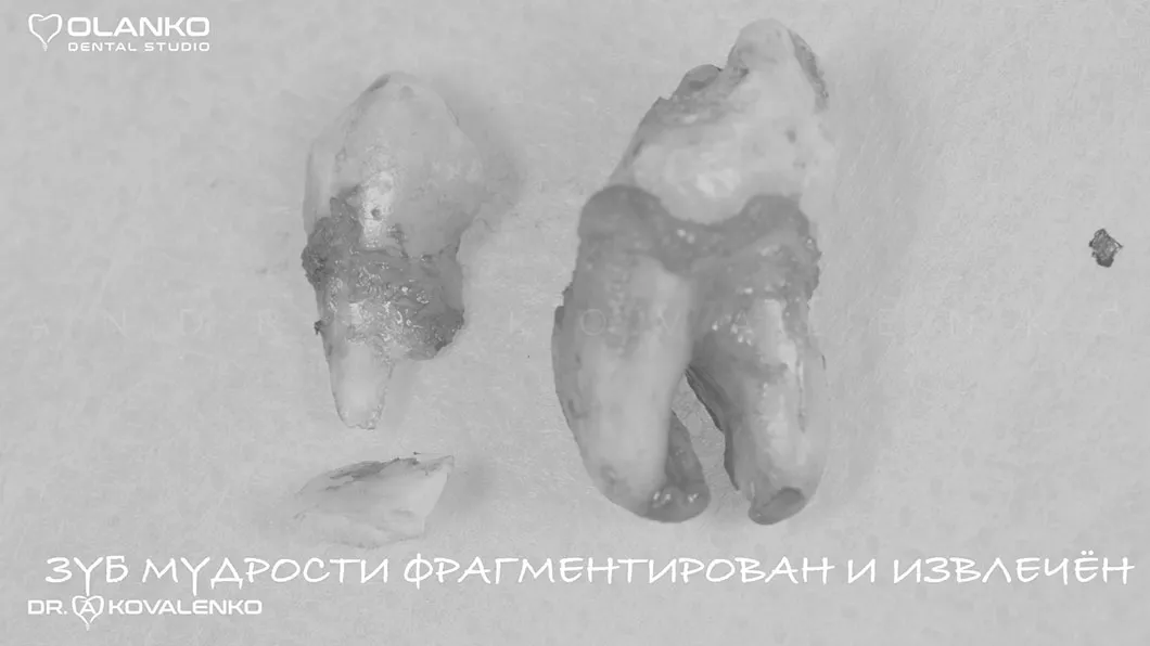 Фото зуб мудрості після видалення Оланко Бровари Київ