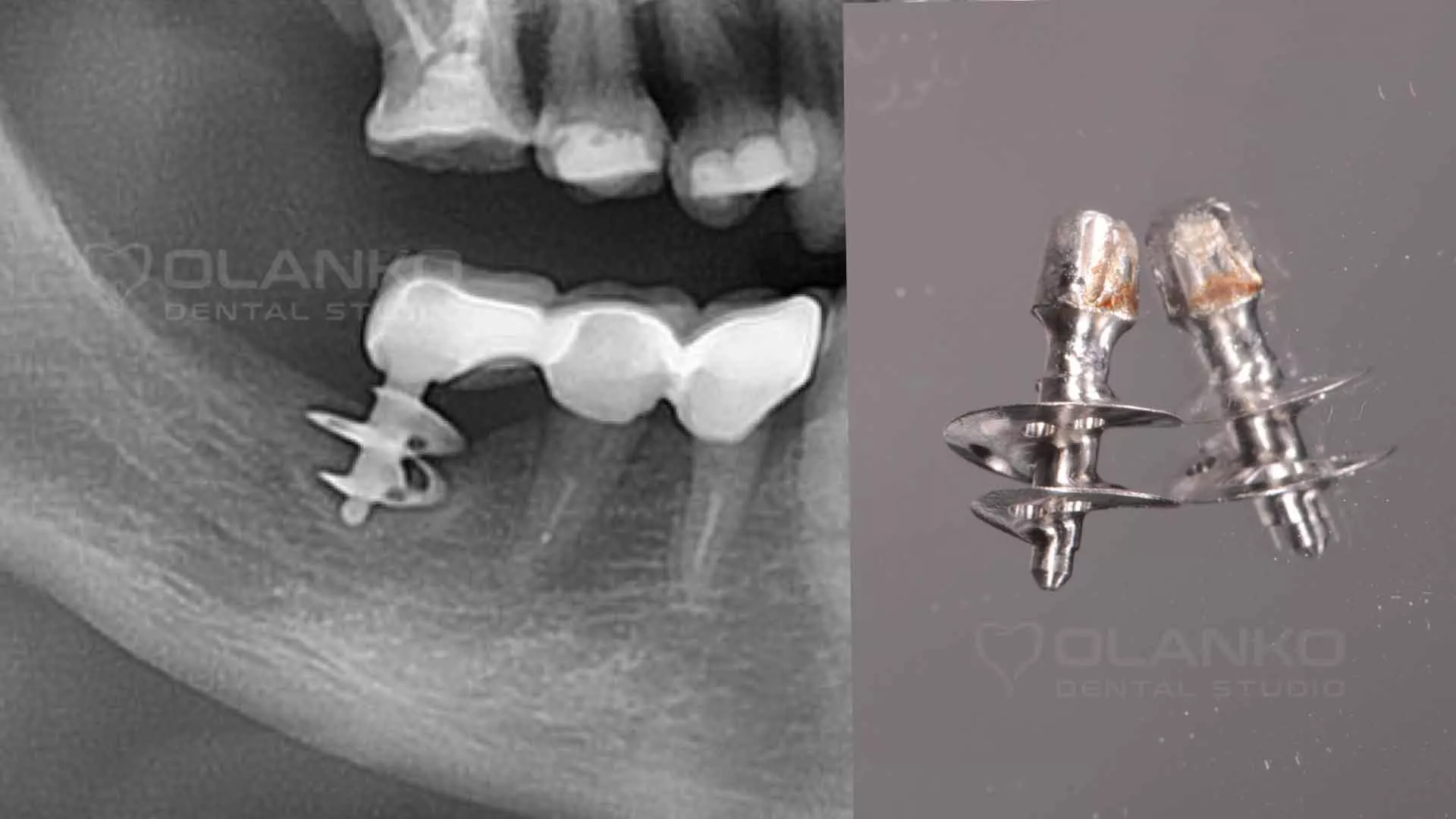 Базальна імплантація Стоматологія Оланко™