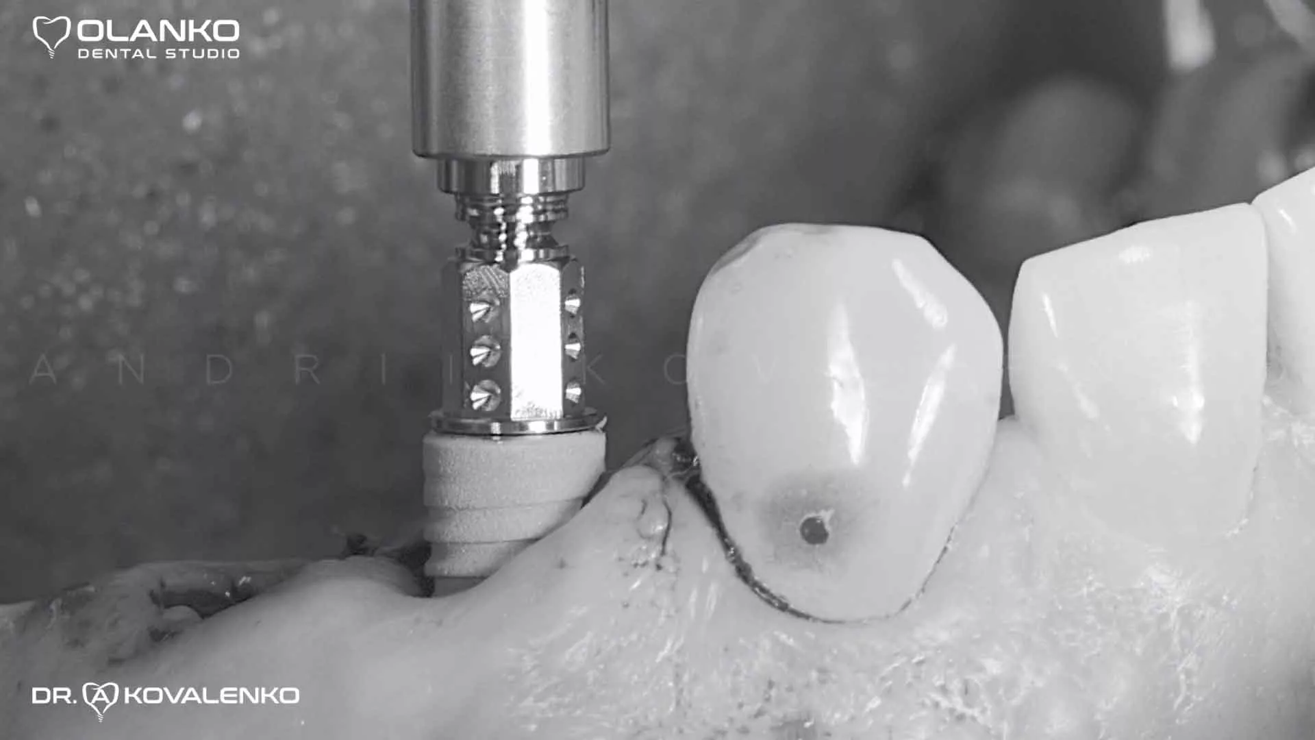 Імпланти Straumann- одні з кращих імплантологічних систем в світі