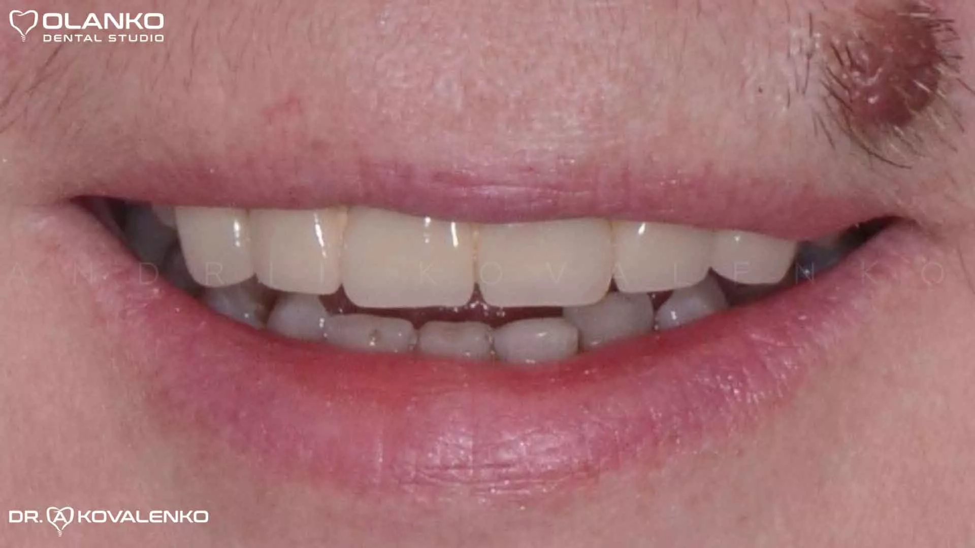 Клінічний випадок 8 імплантація