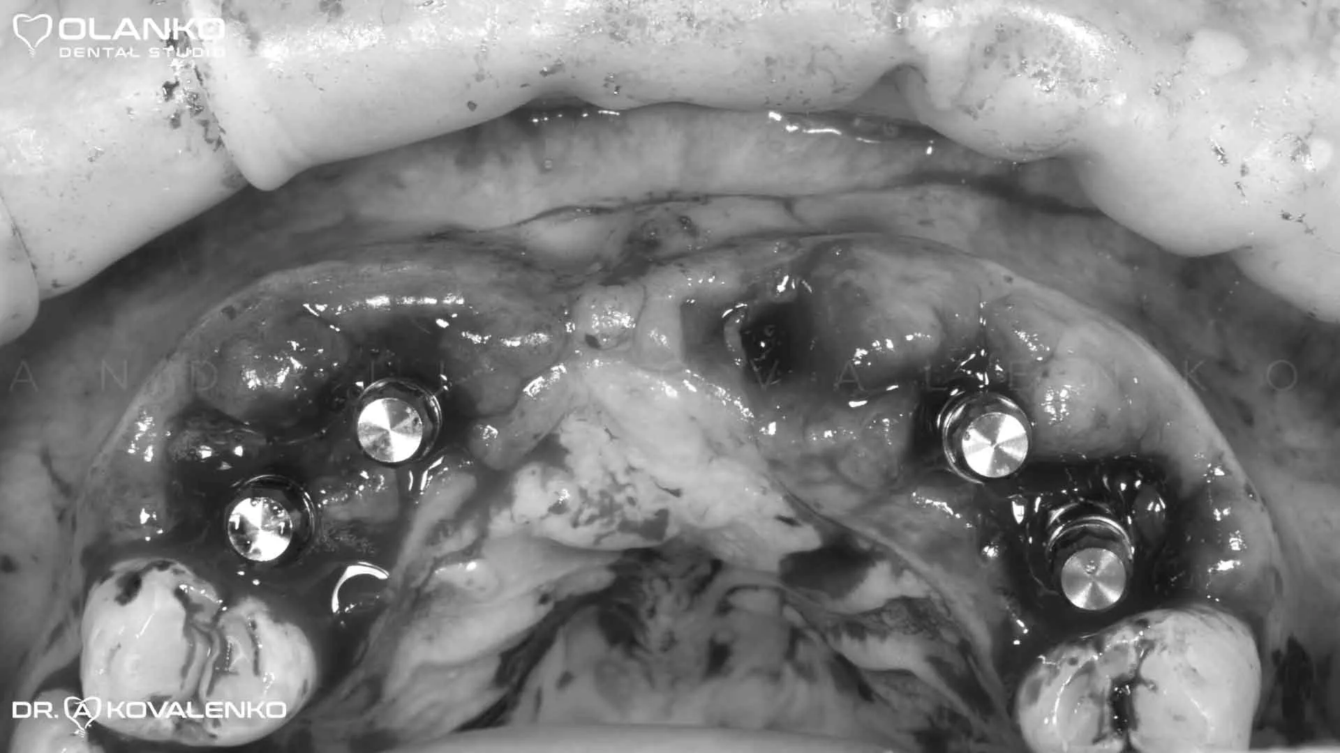 Клінічний випадок 8 імплантація