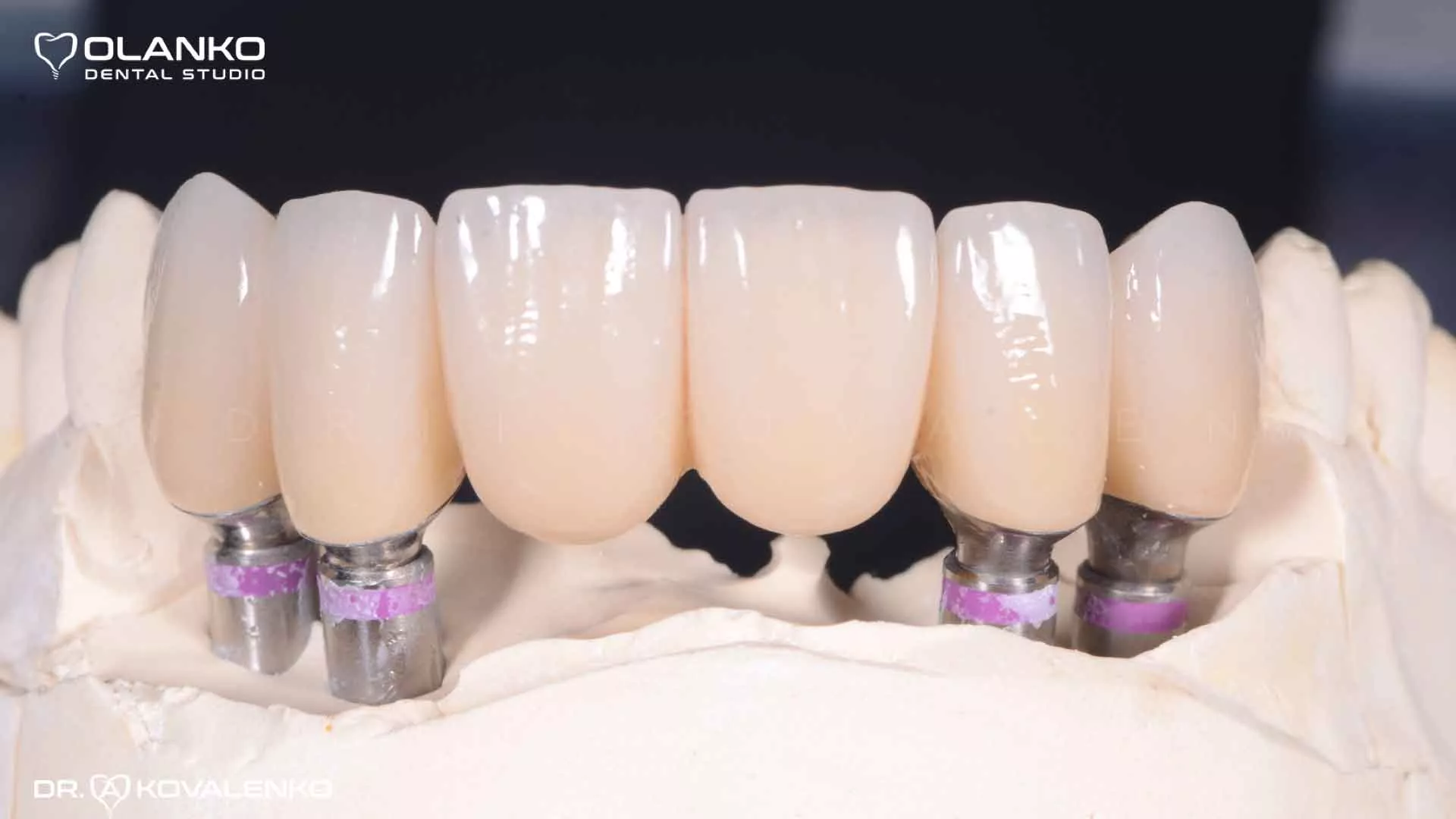 Клінічний випадок 8 імплантація