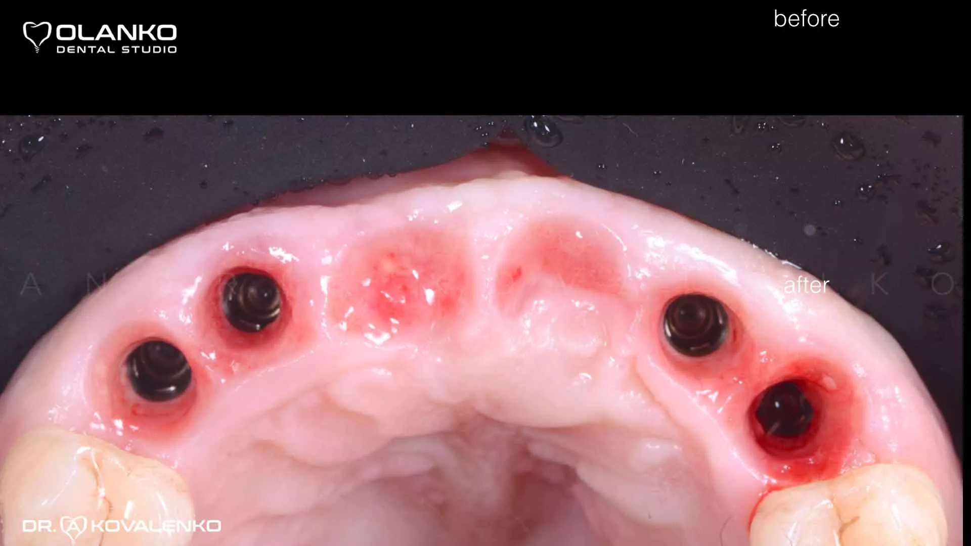 Клінічний випадок 8 імплантація