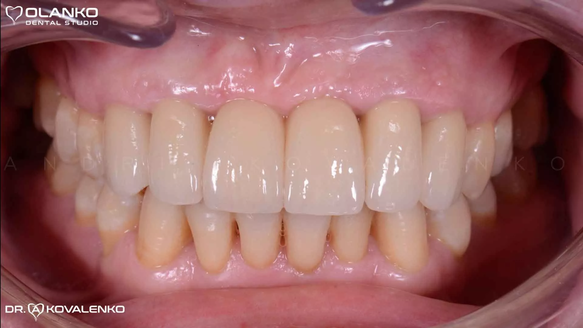 Клінічний випадок 8 імплантація