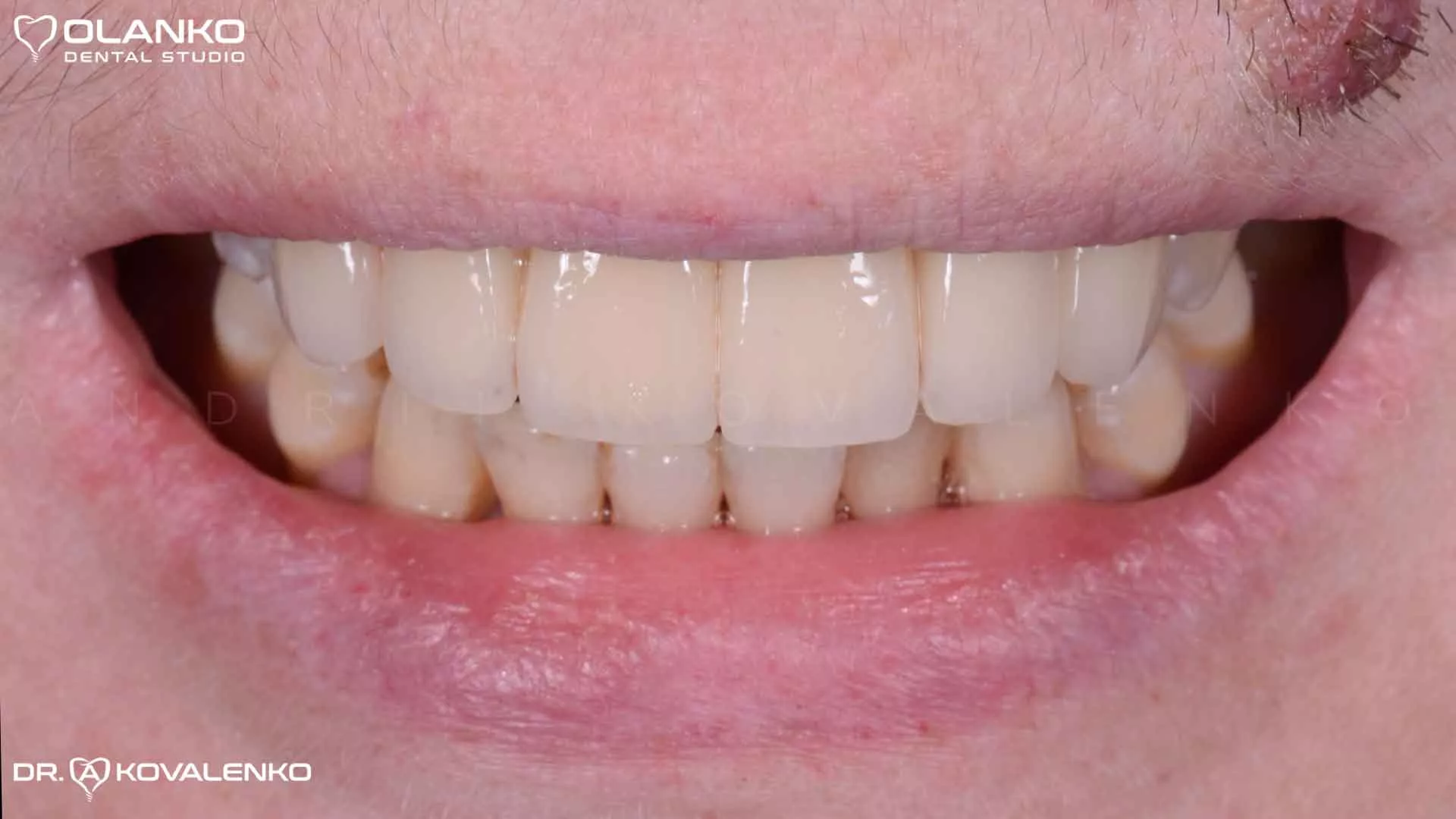 Клінічний випадок 8 імплантація