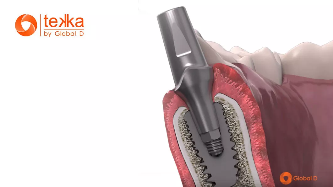 Французький імплант Tekka In-Kone, Франція імплантат Оланко