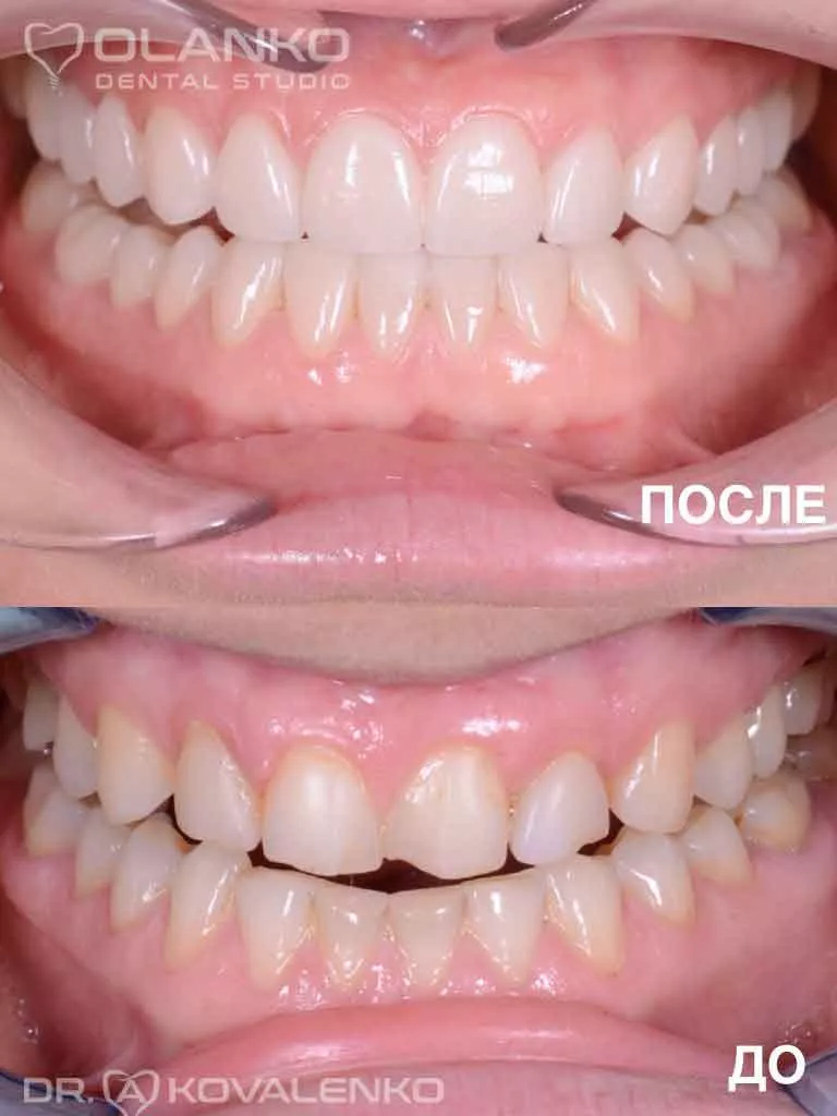 Курамічні вініри на зуби Бровари Київ