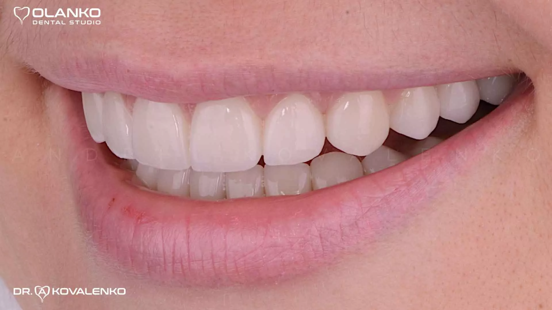 Фото посмішки після встановлення вінірів