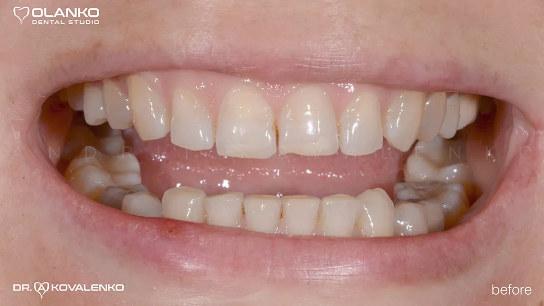 До Вініри на зуби Оланко Бровари