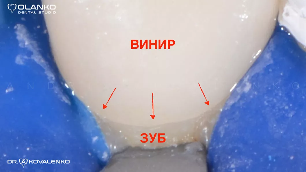 Макрофото, 15-ти кратне збільшення точності прилягання вініра